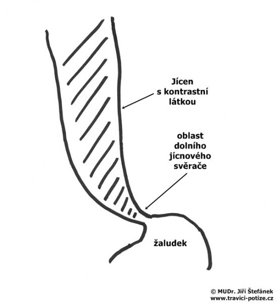 Achalázie