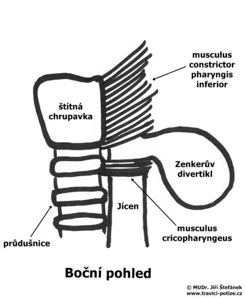 Zenkerův divertikl